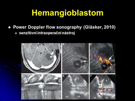 Hemangioblastom Power Doppler flow sonography (Gläsker, 2010)