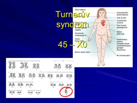 Turnerův syndrom 45 – X0.