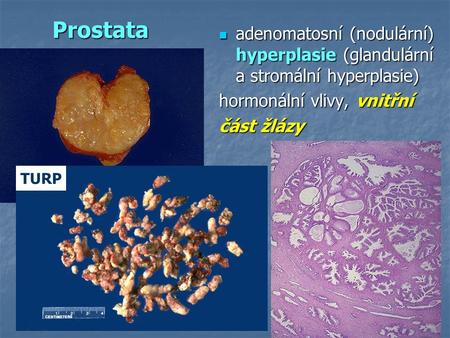 Prostata adenomatosní (nodulární) hyperplasie (glandulární a stromální hyperplasie) adenomatosní (nodulární) hyperplasie (glandulární a stromální hyperplasie)