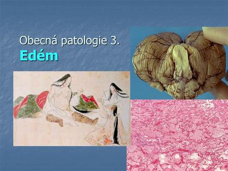 Obecná patologie 3. Edém. Edém izolované buňky (améby) přežívají díky difúzi z prostředí izolované buňky (améby) přežívají díky difúzi z prostředí buňky.