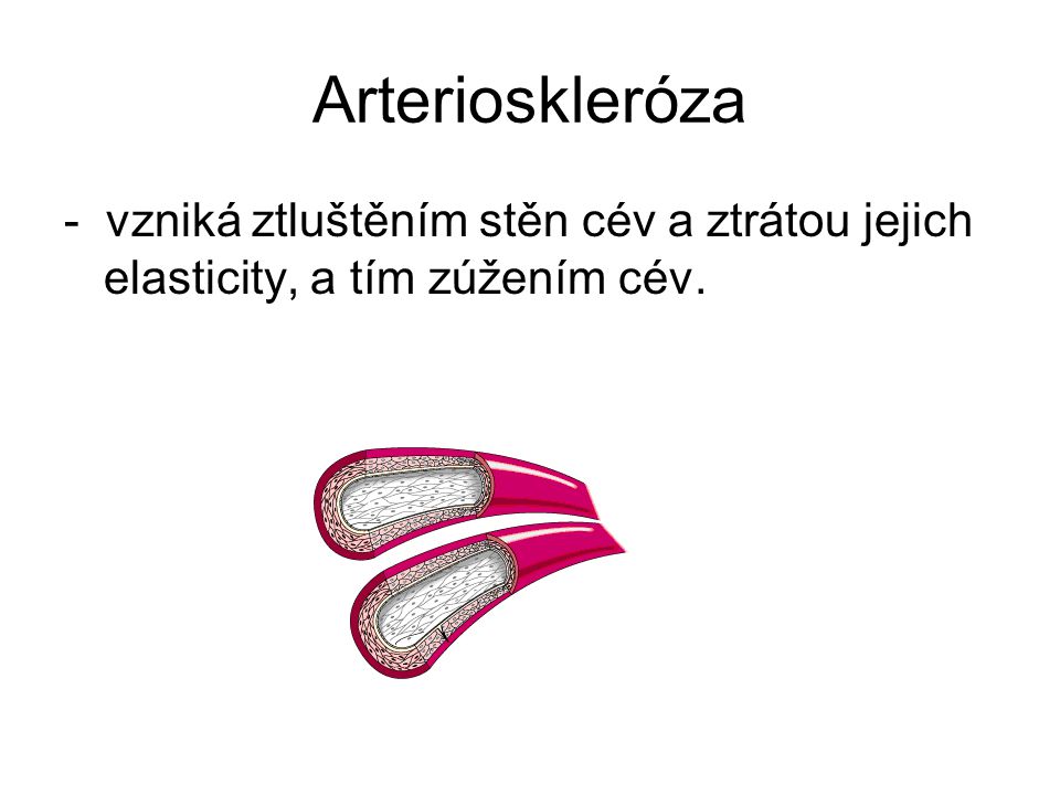 Arterioskleróza - vzniká ztluštěním stěn cév a ztrátou jejich elasticity, a tím zúžením cév.