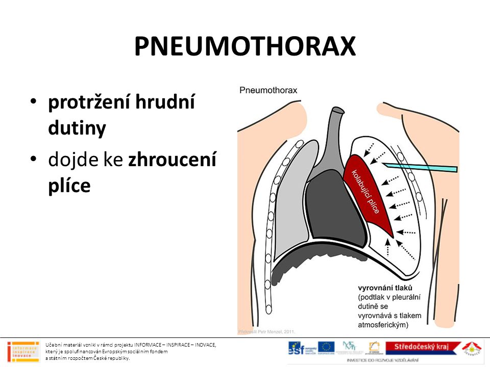 PNEUMOTHORAX protržení hrudní dutiny dojde ke zhroucení plíce