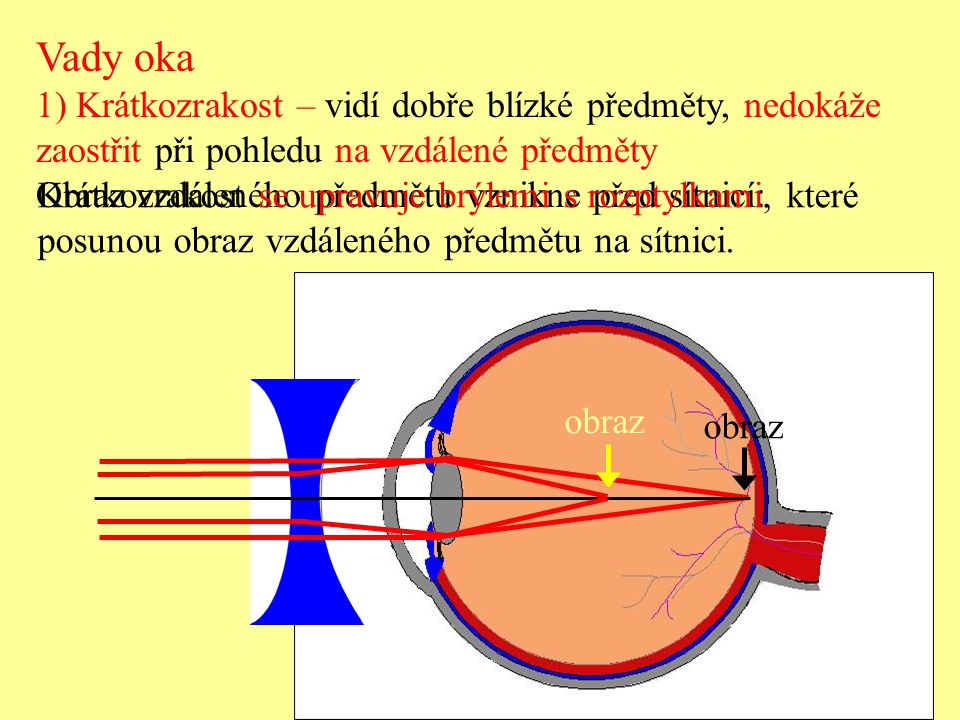 Vady oka 1) Krátkozrakost – vidí dobře blízké předměty, nedokáže