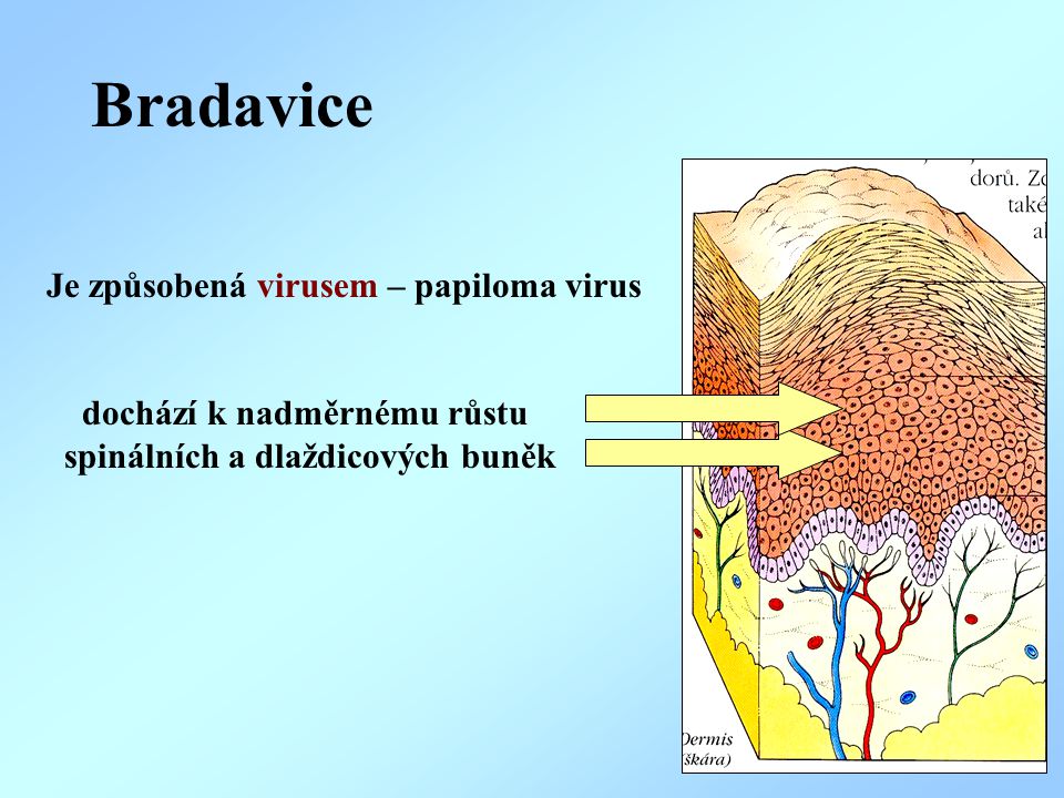 Bradavice Je způsobená virusem – papiloma virus