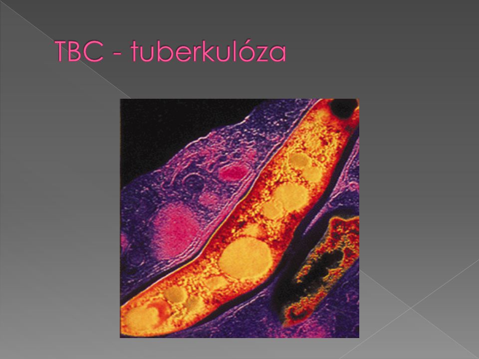 TBC - tuberkulóza