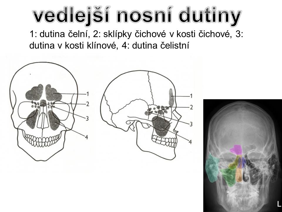 vedlejší nosní dutiny 1: dutina čelní, 2: sklípky čichové v kosti čichové, 3: dutina v kosti klínové, 4: dutina čelistní.