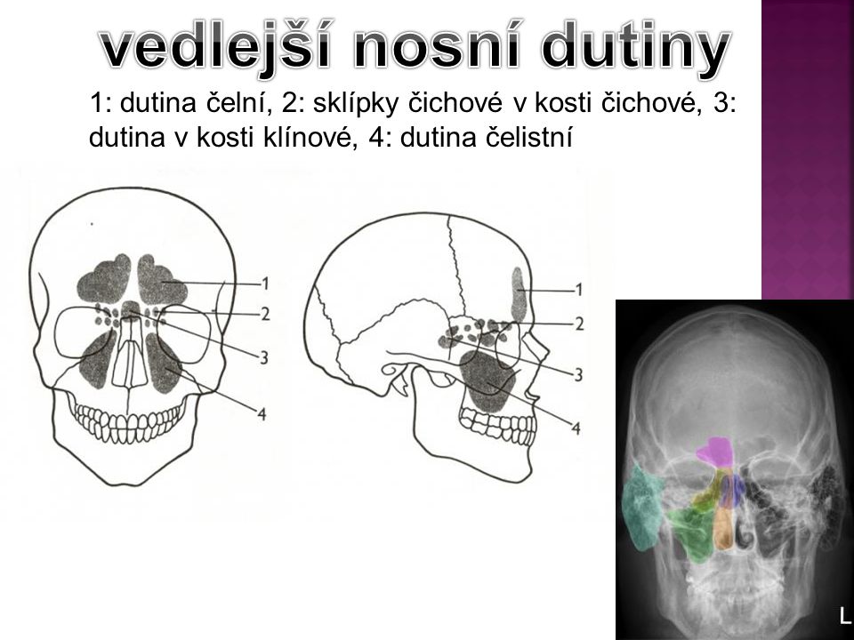 vedlejší nosní dutiny 1: dutina čelní, 2: sklípky čichové v kosti čichové, 3: dutina v kosti klínové, 4: dutina čelistní.