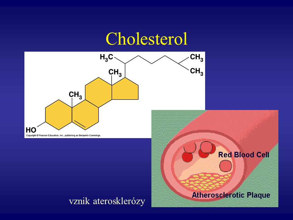 Cholesterol vznik aterosklerózy