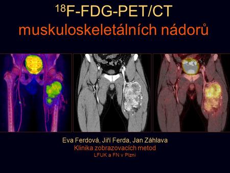 18F-FDG-PET/CT muskuloskeletálních nádorů