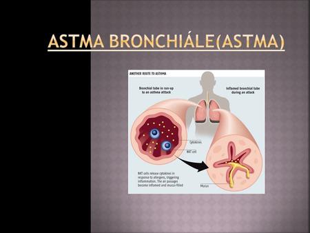 Astma bronchiále(astma)