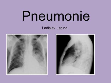 Pneumonie Ladislav Lacina.