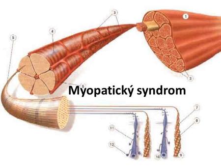 Myopatický syndrom.