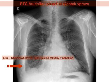 RTG hrudníku: pleurální výpotek vpravo