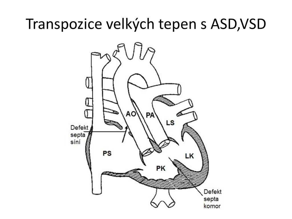 Vrozené Srdeční Vady Seminář 5ročník Ppt Stáhnout 