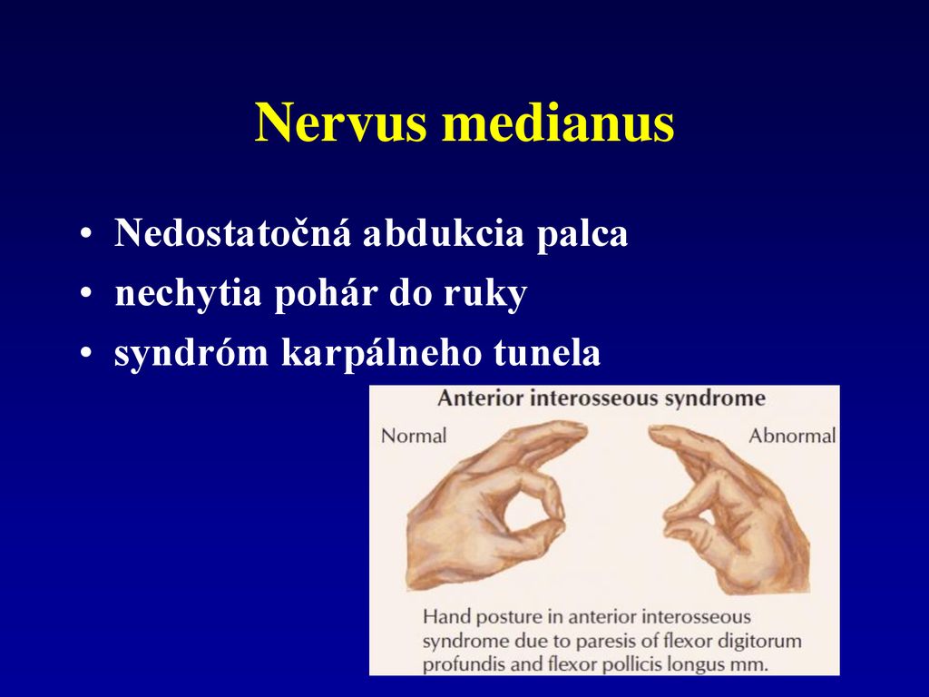 Nervus medianus Nedostatočná abdukcia palca nechytia pohár do ruky