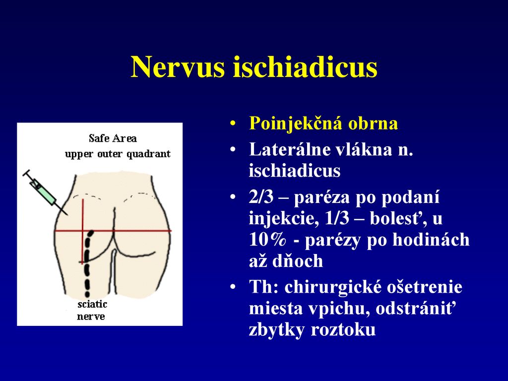 Nervus ischiadicus Poinjekčná obrna Laterálne vlákna n. ischiadicus