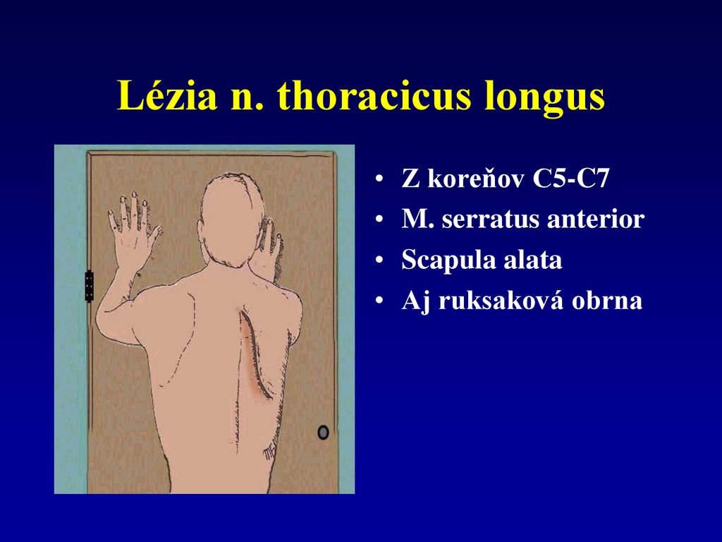 Lézia n. thoracicus longus