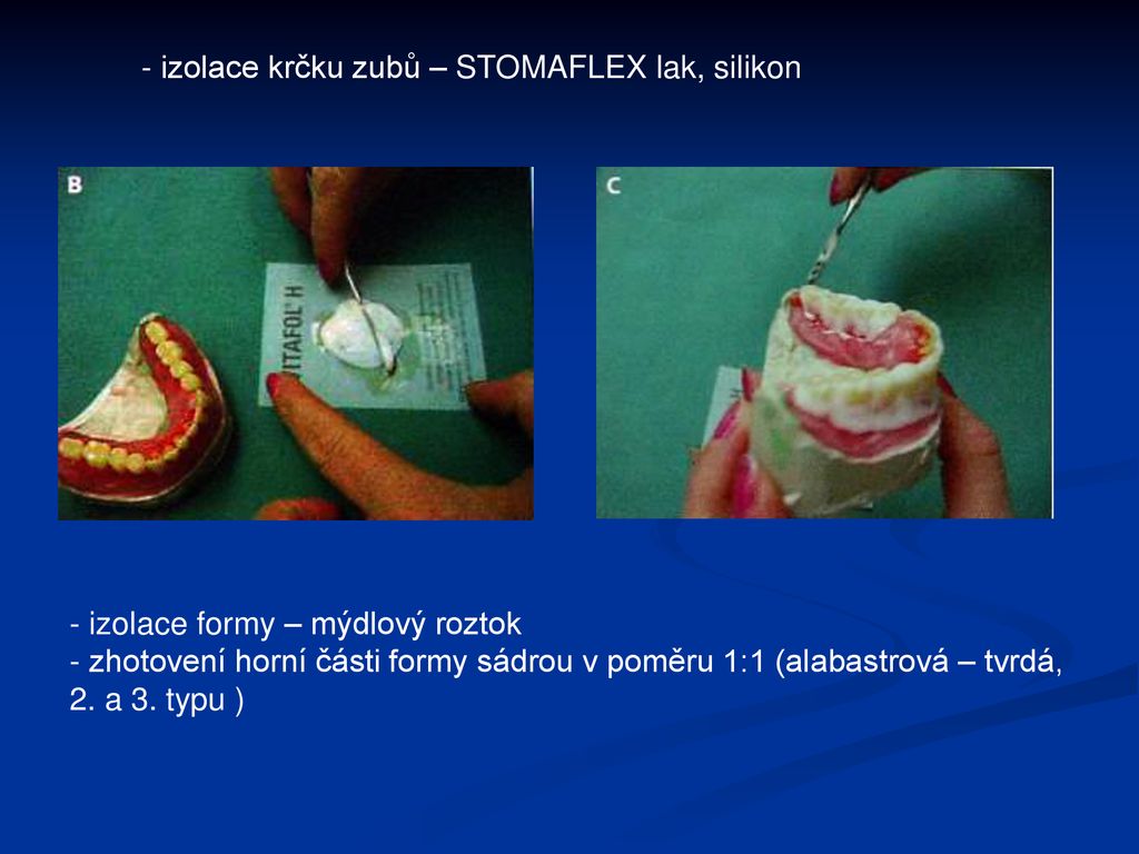 - izolace krčku zubů – STOMAFLEX lak, silikon