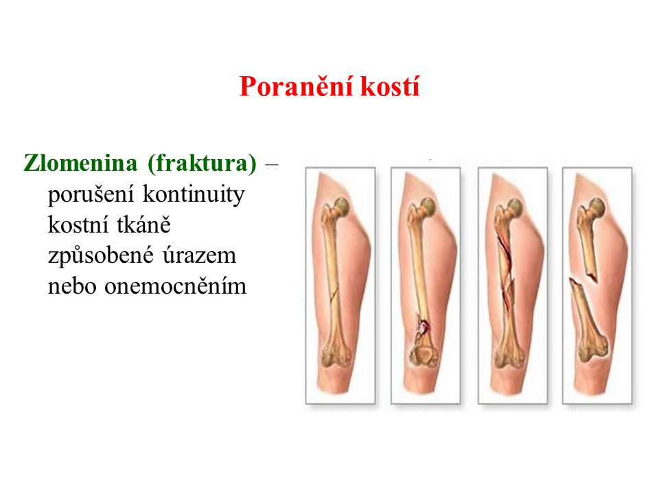 Poranění kostí Zlomenina (fraktura) – porušení kontinuity kostní tkáně způsobené úrazem nebo onemocněním.