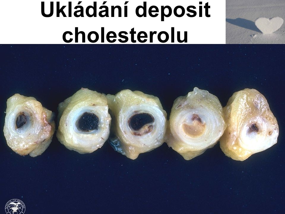 Ukládání deposit cholesterolu