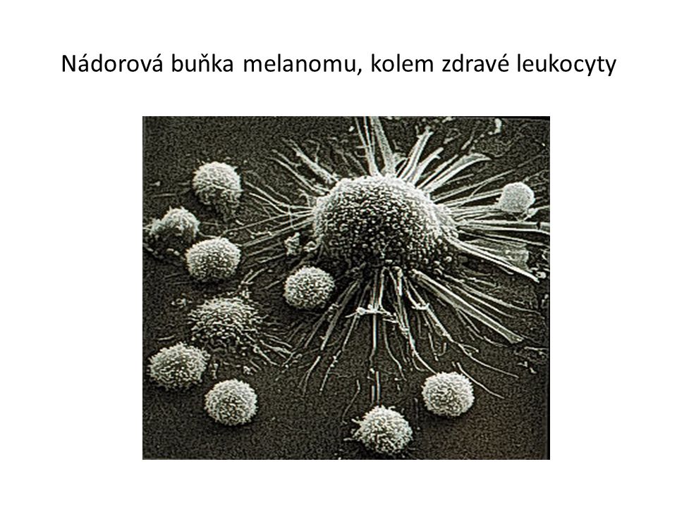 Nádorová buňka melanomu, kolem zdravé leukocyty