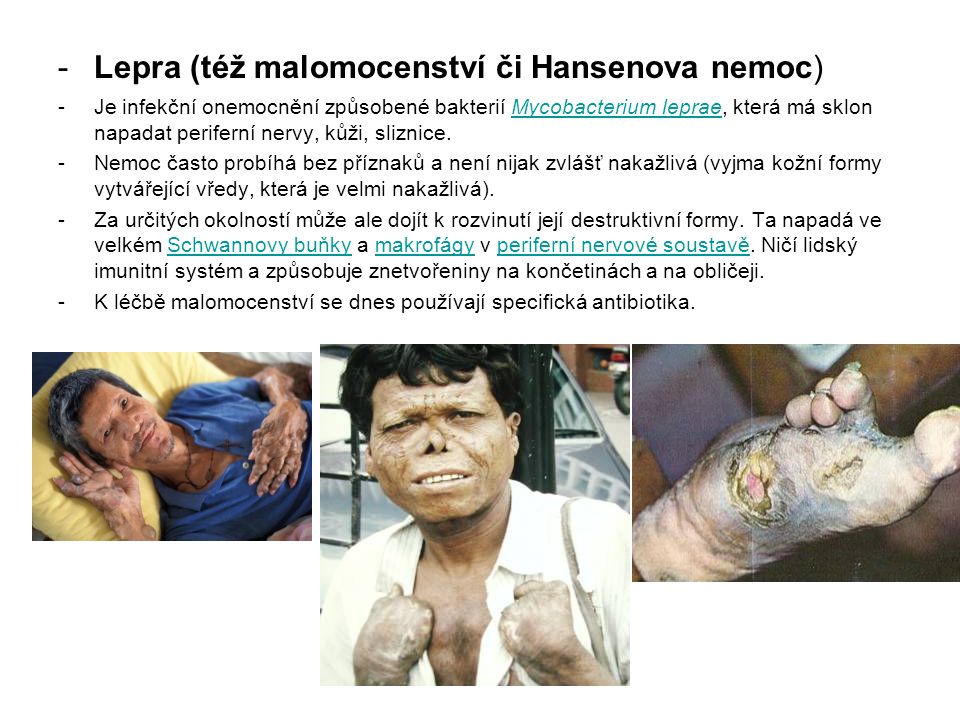 Lepra (též malomocenství či Hansenova nemoc)