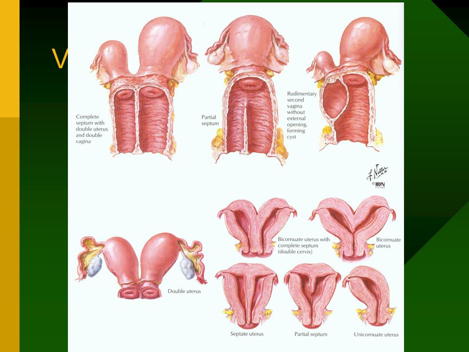 Uterus Didelphys Porn