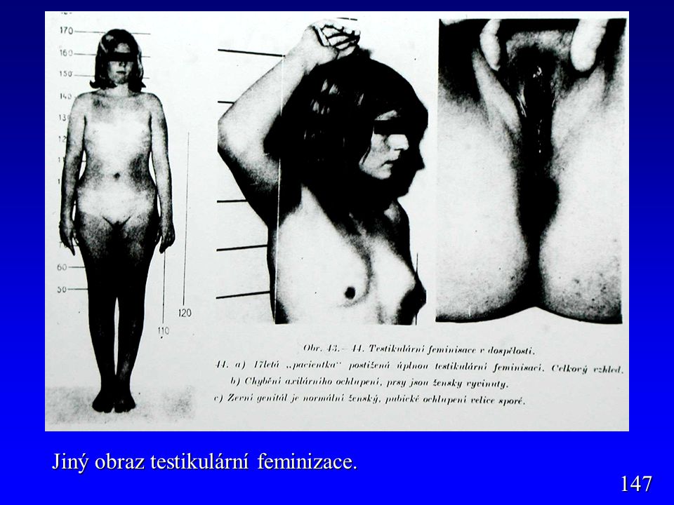 Jiný obraz testikulární feminizace.