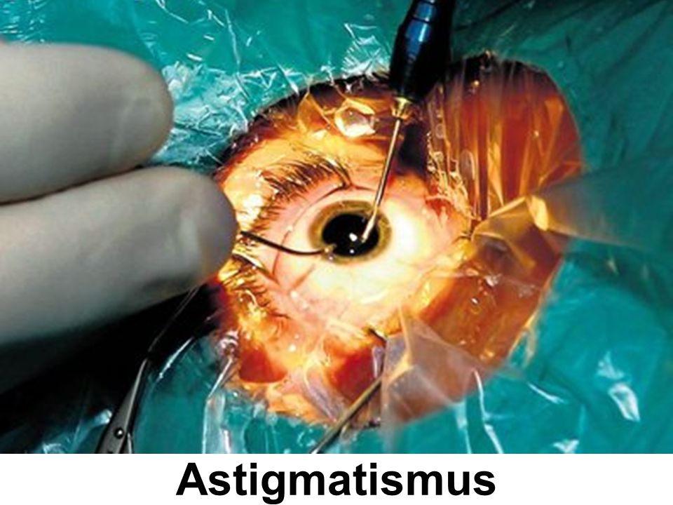 Astigmatismus