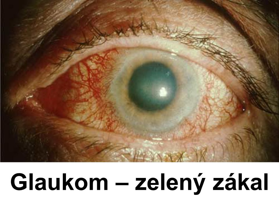 Glaukom – zelený zákal