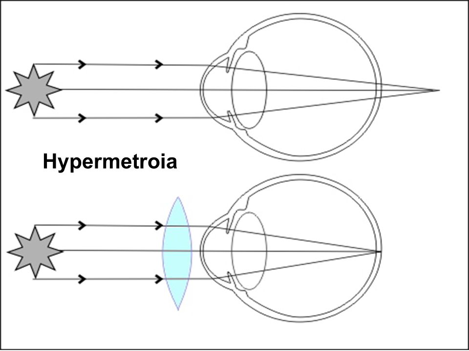 Hypermetroia
