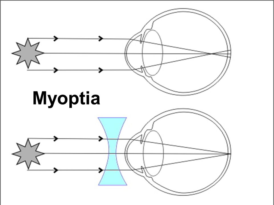 Myoptia