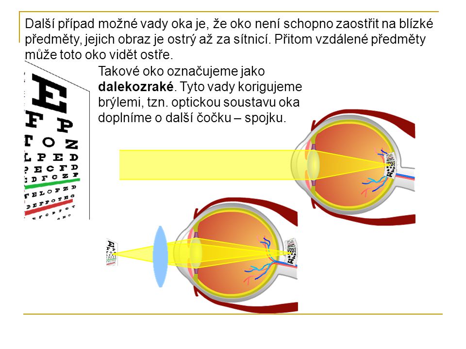 Další případ možné vady oka je, že oko není schopno zaostřit na blízké předměty, jejich obraz je ostrý až za sítnicí. Přitom vzdálené předměty může toto oko vidět ostře.