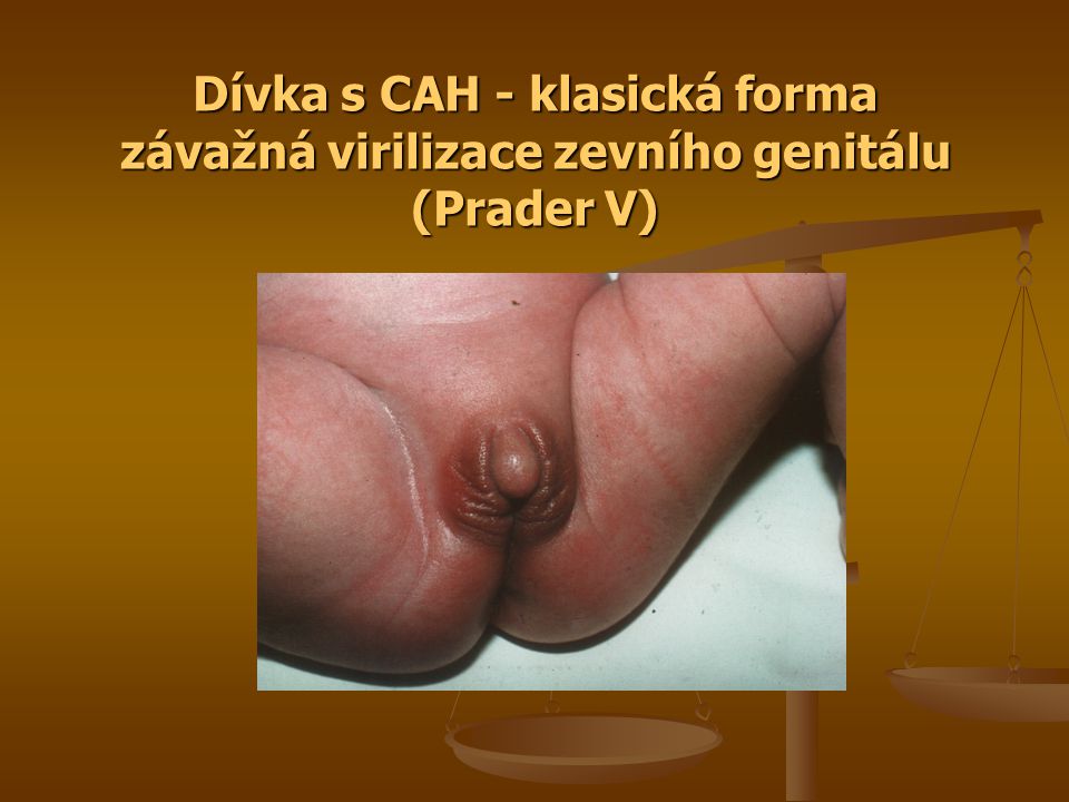 Dívka s CAH - klasická forma závažná virilizace zevního genitálu (Prader V)
