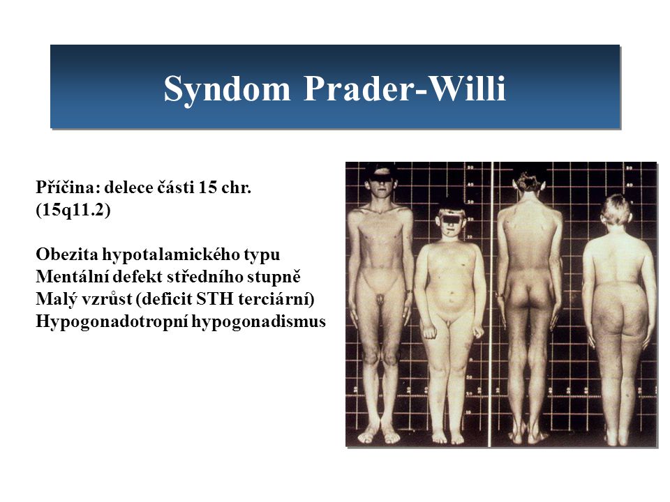 Syndom Prader-Willi Příčina: delece části 15 chr. (15q11.2)