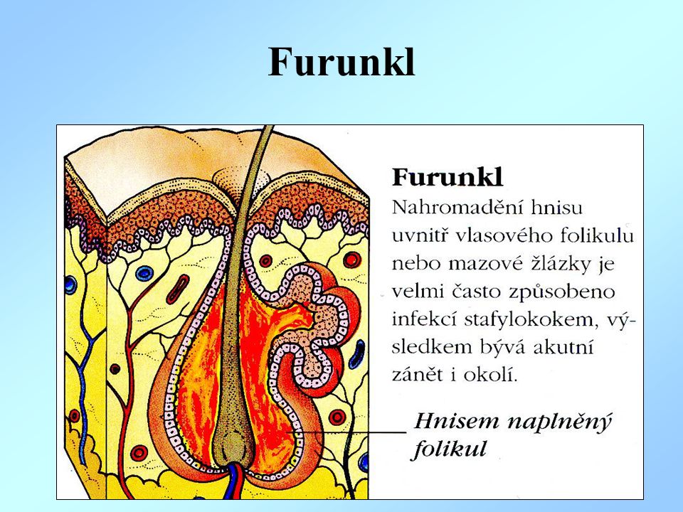 Furunkl