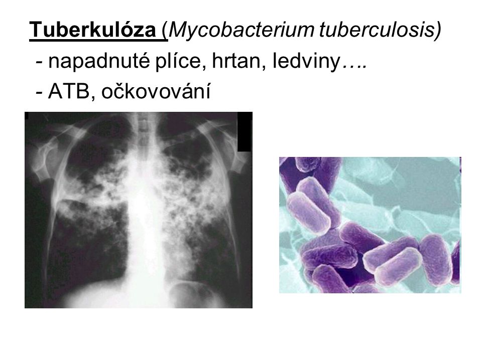 Tuberkulóza (Mycobacterium tuberculosis)