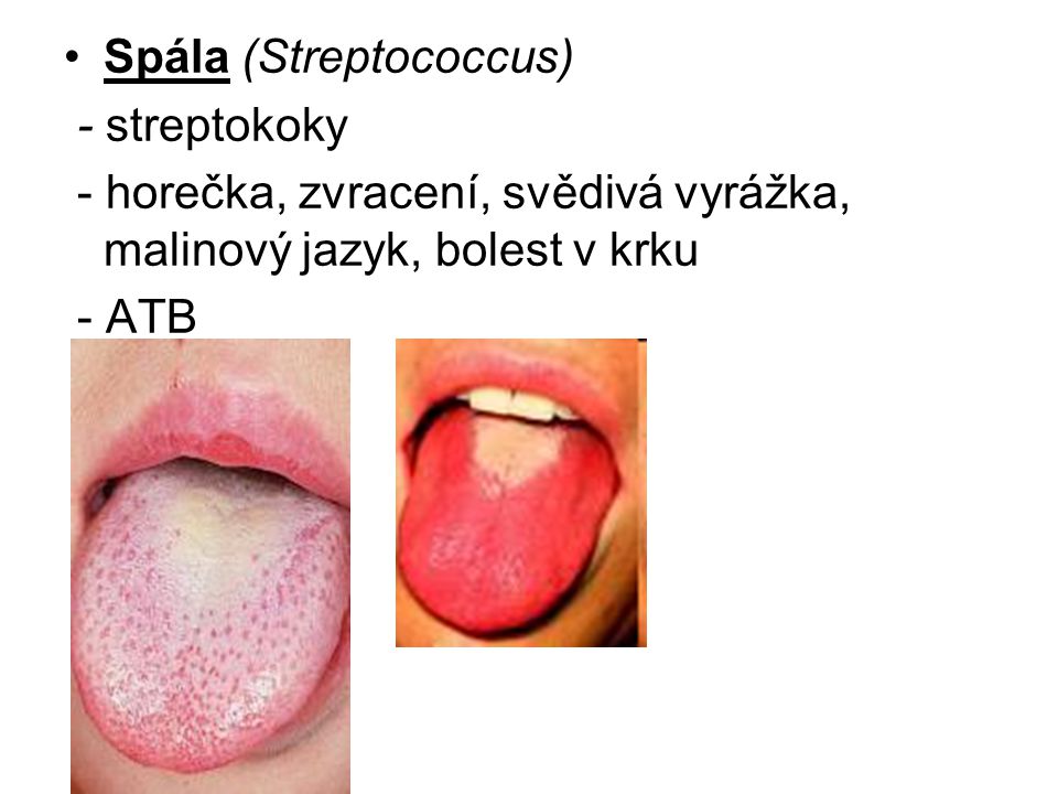 Spála (Streptococcus)