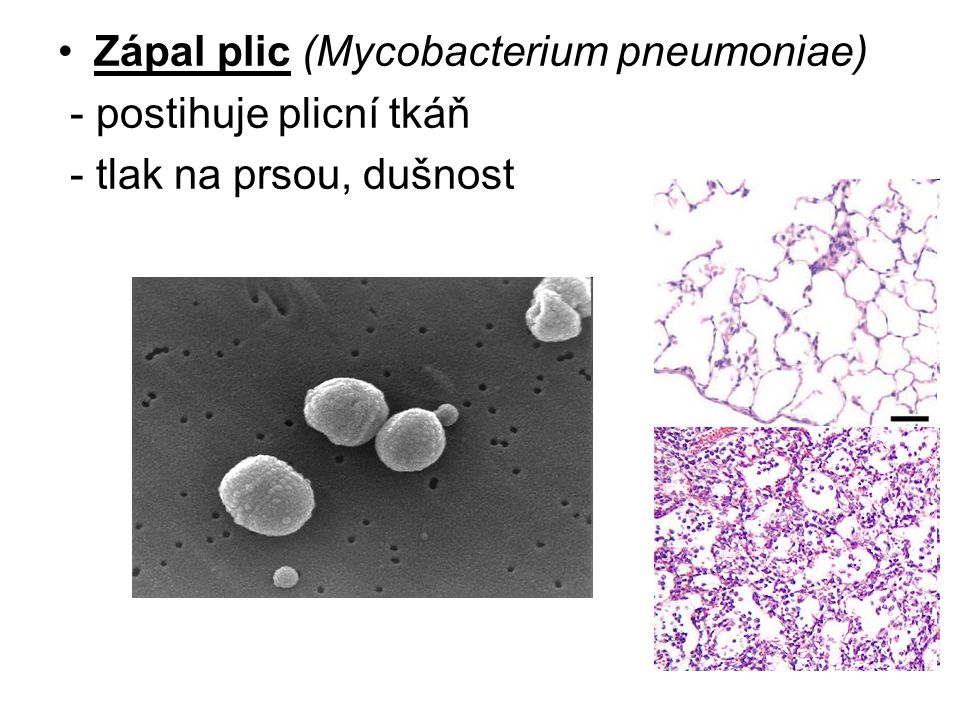 Zápal plic (Mycobacterium pneumoniae)