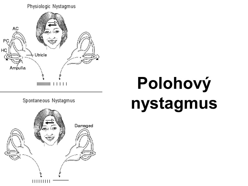 Polohový nystagmus