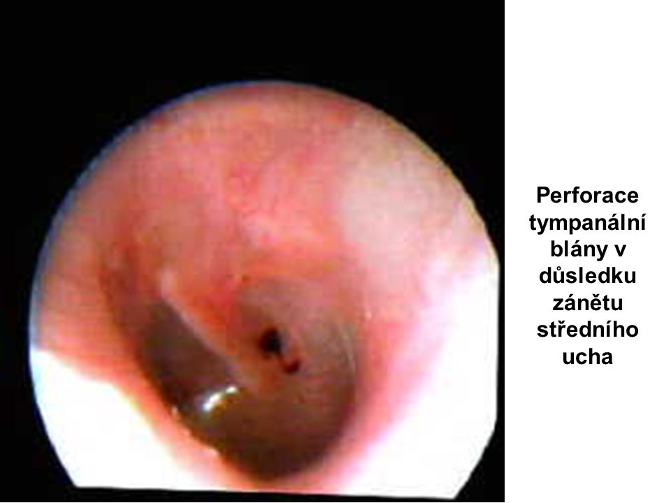 Perforace tympanální blány v důsledku zánětu středního ucha