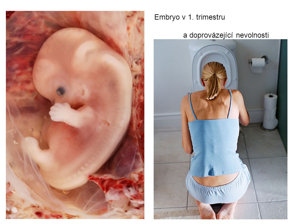 Embryo v 1. trimestru a doprovázející nevolnosti