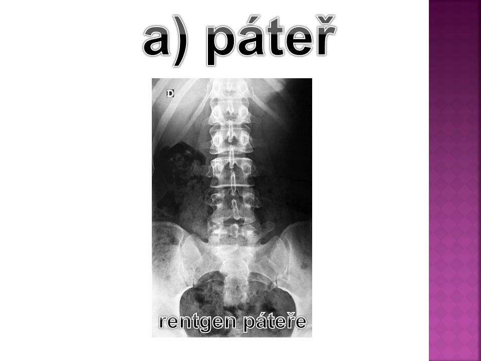 a) páteř rentgen páteře