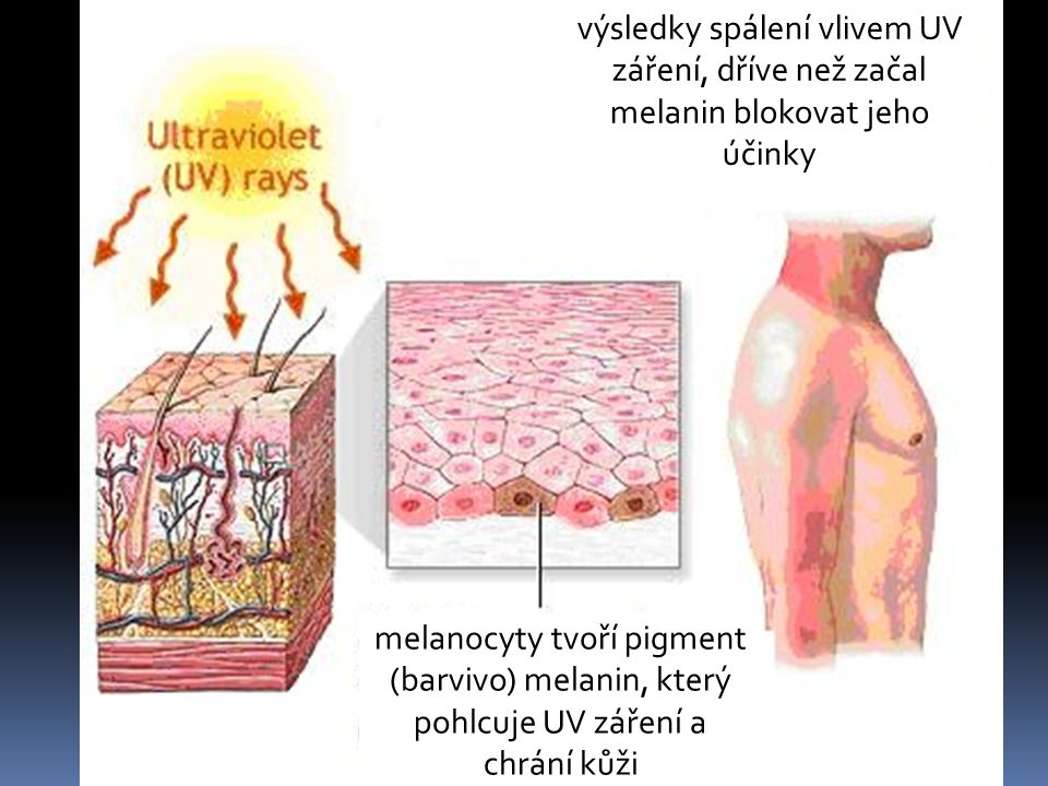 výsledky spálení vlivem UV záření, dříve než začal melanin blokovat jeho účinky