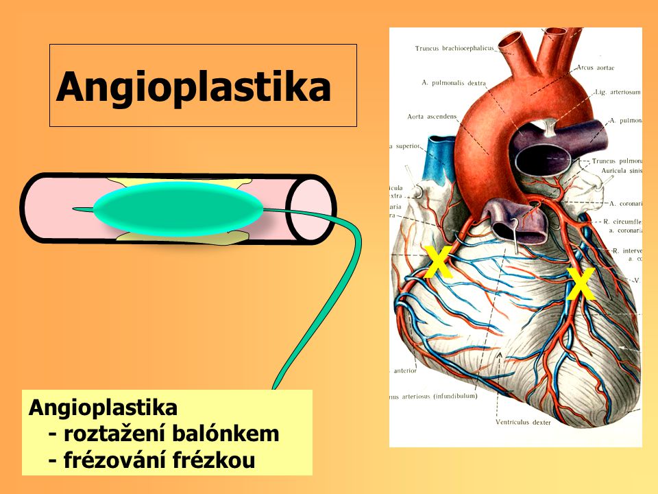 X X Angioplastika Angioplastika - roztažení balónkem