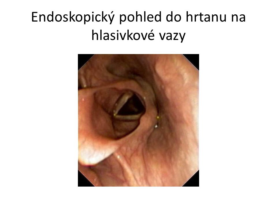 Endoskopický pohled do hrtanu na hlasivkové vazy