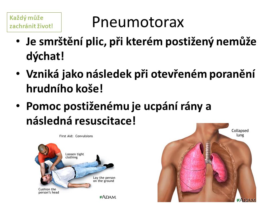 Pneumotorax Je smrštění plic, při kterém postižený nemůže dýchat!