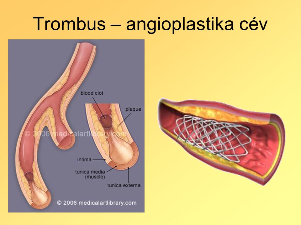 Trombus – angioplastika cév