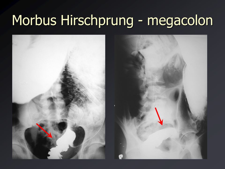 Morbus Hirschprung - megacolon