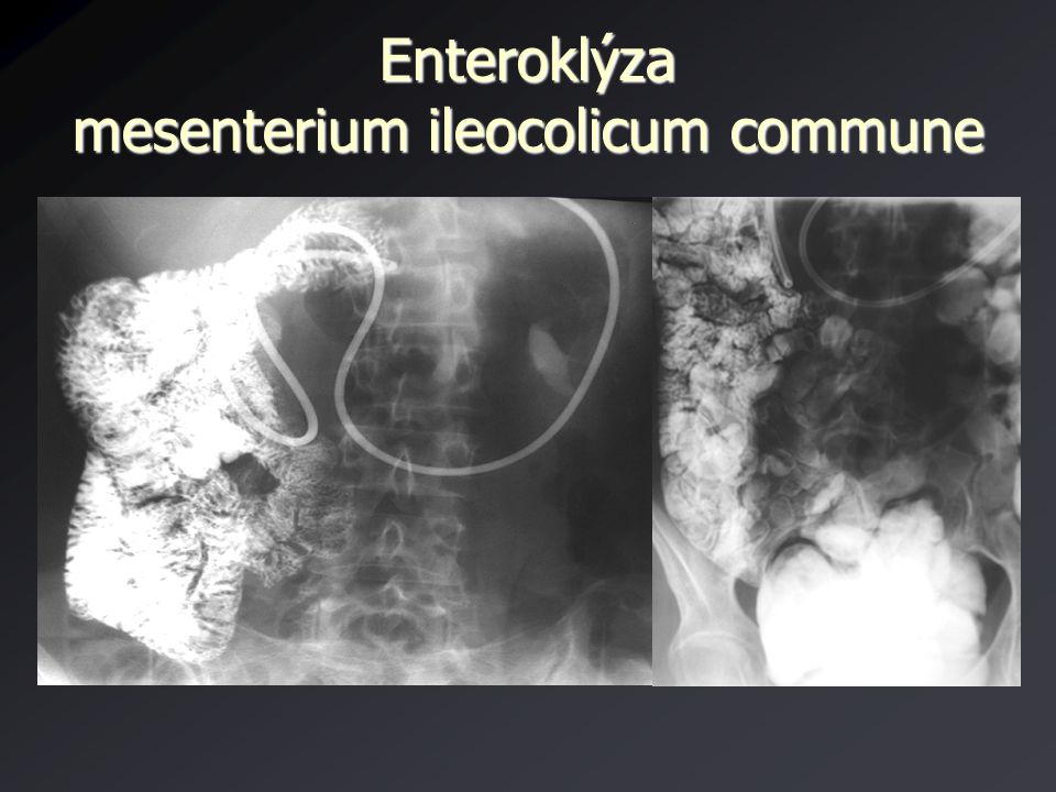 Enteroklýza mesenterium ileocolicum commune